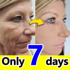20 years younger, 100% wrinkles disappear